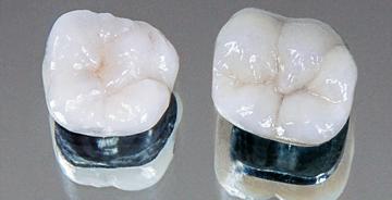 Metal Ceramic Restoration